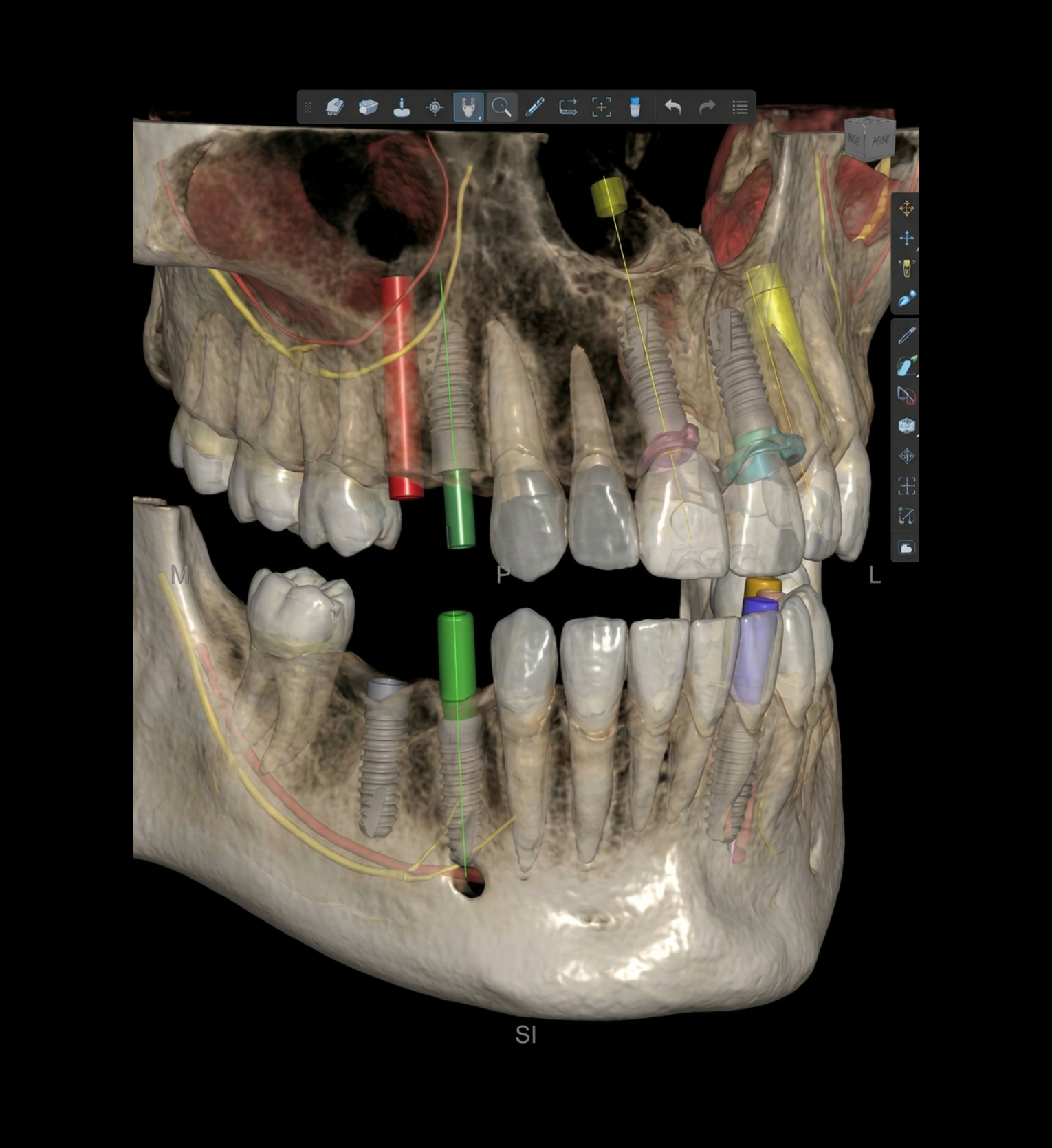 impianto denti roma