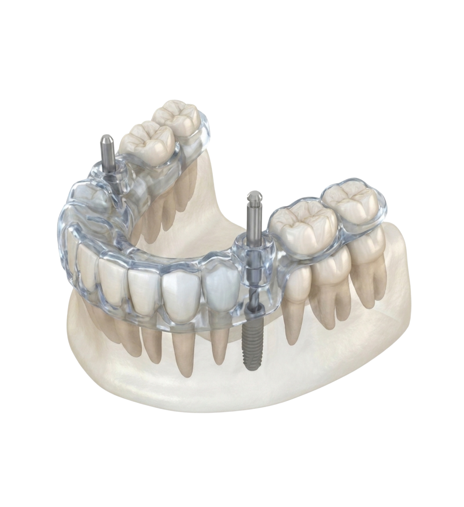 impianti dentali roma